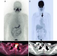 Certain changes in a person's dna can cause thyroid cells to become cancerous. A 61 Year Old Male With Papillary Thyroid Cancer Received Total Download Scientific Diagram