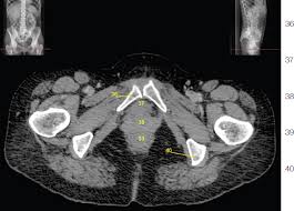 Anatomy ct axial abdomen and pelvis male from 3.bp.blogspot.com the lateral superficial muscles, the transversus and external and internal oblique muscles, originate on the rib cage and on the pelvis (iliac crest and inguinal ligament) and are attached to the anterior and posterior layers of the sheath of the rectus. Pelvis And Abdomen Radiology Key