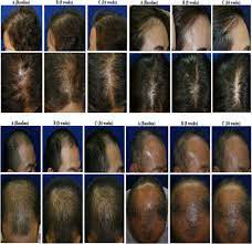Updates Cures For Hair Loss 2021 Follicle Thought