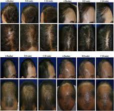 Locations in charlotte, las vegas, orlando, phoenix and san francisco. Updates Cures For Hair Loss 2021 Follicle Thought