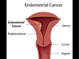 If symptoms develop, the most common sign is vaginal bleeding that occurs between menstrual periods or after menopause. Endometrial Cancer Youtube