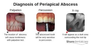 Image result for Periapical Abscess