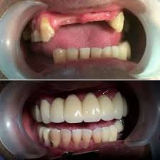 We did not find results for: Pasang Gigi Palsu Murah Berkualitas Perawatan 794604002