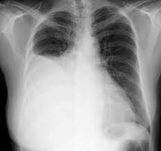 As little as 5 ml of pleural fluid can be detected by elevating the patient's hips and aiming the central beam at the lateral chest wall parallel to the expected fluid level. Pleural Effusion Pathology Britannica