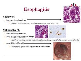 The cases of esophagitis caused by hsv can be endoscopically characterized by multiple ulcers as they are punched out with sharp edges or borders. Reflux Esophagitis And Esophageal Carcinoma Thomas Rosenzweig Md Ppt Download