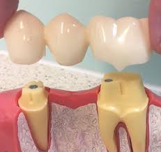 Mesela bir zirkonyum diş kaplama ile porselen diş kaplama fiyatı büyük farklılık gösterecektir. Kopruler Discim Istanbul