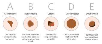 Hautkrebs Praevention Dermapharm