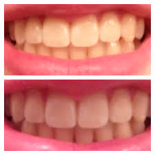 This article explains the signs and symptoms of cavities and how to know if you have one. Coconut Oil To Whiten Teeth Reddit Teethwalls