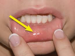 Image result for Labial mucosa