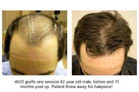 Worried About Hair Transplant Cost Hair Transplant Cost Hair Transplant Fue Hair Transplant
