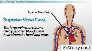 What Is Superior Vena Cava Syndrome Superior Vena Cava Syndrome Vena Cava Syndrome
