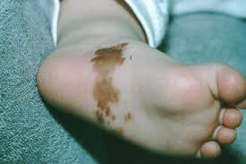 Image result for brown patches on the feet