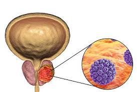 When recognized with breast cancer, this can be an amazing expertise. Robotic Prostate Cancer Surgery Benefits Costs Risks Success Rate