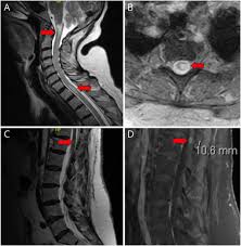 Image result for Myelitis
