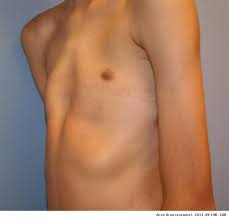 Usually first noticed in the early teen years, it can be corrected with minimally invasive or traditional open surgeries. Dysmorphology Of Chest Wall Deformities Frequency Distribution Of Subtypes Of Typical Pectus Excavatum And Rare Subtypes Archivos De Bronconeumologia English Edition