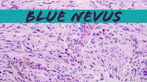 Image result for Blue Nevus