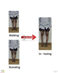Image result for Foot Progression Angle