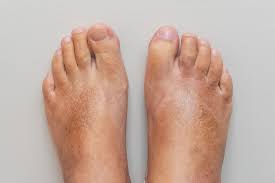 Image result for Dactylitis