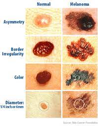 The first documentation of symbolic ribbons comes from medieval times. Skin Cancer Awareness Get Checked Nebraska Methodist Health System