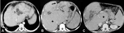 Axial Ct Scan Of The Liver Shows Multiple Hypodense Lesions In The Left Download Scientific Diagram