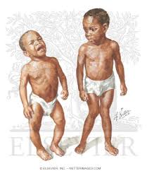 Image result for Genu Varum