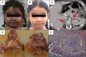 Ppnad is more frequent in females, especially after puberty. Primary Pigmented Nodular Adrenocortical Disease Ppnad Single Centre Experience