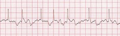 Atrial Fibrillation Training Acls Cardiac Rhythms Video Proacls