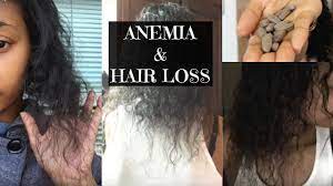 You may find hair loss due to iron deficiency similar to female or male pattern hair loss as your hair starts to shed off unusually. Anemia Hair Loss My Story And Recovery Youtube