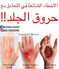 مراحل شفاء الحروق من الدرجة الثانية بالصور