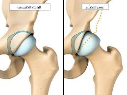 معنى كلمة خلع الورك الولادي أعزائي كثير العيادة الاستشارية لطب الأطفال استشاري الأطفال د عارف نجدت قواس Facebook