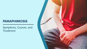 Image result for paraphimosis