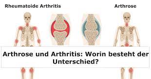 Arthrose Und Arthritis Worin Besteht Der Unterschied Bewegen Ohne Schmerzen