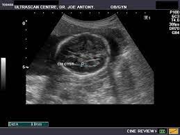 Ultrasound Images Of Fetal Brain