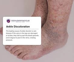 Image result for liver spots on legs