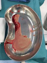 However the cause of a bartholin cyst is the backup of fluid in the gland; Pus From A Bartholin S Cyst After Surgical Incision Popping