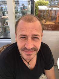 haartransplantation forum hairmedic hairmedic transplantiert willi herren