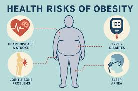 Obesity and Your Health: When to Consider Bariatric Surgery - MASSH