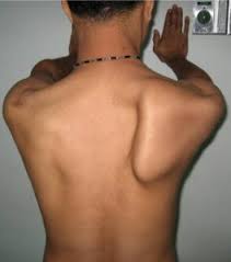 I wish there was a quick fix but i am pretty sure i have been winging during exercises. What Is Scapular Winging And Should I Care Move Better Feel Better