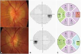 Other visual symptoms include seeing blobs of varying size and shape (floaters) and continuing to see images after they are out of the line of sight. Neuro Ophthalmologic Findings In Visual Snow Syndrome
