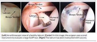 Image result for SLAP Lesion