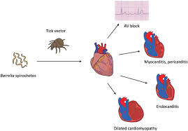 Image result for Lyme Carditis