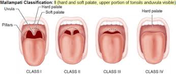 High mallampati score and nasal obstruction are associated risk factors for obstructive sleep apnoea. Is The Mallampati Score Useful For Emergency Department Airway Management Or Procedural Sedation Sciencedirect