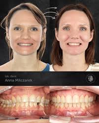 U Pani Moniki zdiagnozowaliśmy ząb zatrzymany , a także patologiczne  starcie zębów i nieprawidłowości zębowe w postaci stłoczeń zębów. ◾️W  pierwszym etapie, leczenie polegało na chirurgicznym odsłonięciu zęba  zatrzymanego i wprowadzeniu go