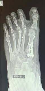 Komplikationen Der Tarsometatarsale I Arthrodese Modifizierte Lapidus Arthrodese Sciencedirect