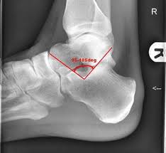 Image result for Calcaneus Compression Fracture