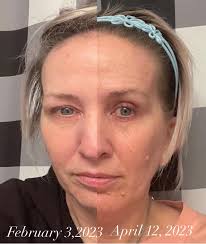 Consistent face washing with right products