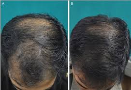 We did not find results for: Botox Injections For Hair Growth In Men Hairguard