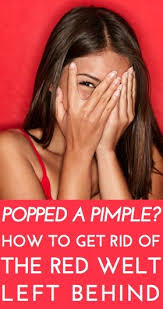 What To Do If You Ve Popped A Pimple And Now Have An Unsightly Swollen Red Mark Left Behind Expert Tips That Really H Beauty Hacks Beauty Guide Redness Pimple