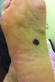 Consequently, this can lead to delays in diagnosis. The Lesion Over The Sole Of Patient S Right Foot Measuring 15 20 Mm In Download Scientific Diagram