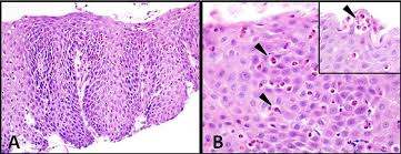 This form of esophagitis typically occurs when. Eosinophilic Oesophagitis Clinical Presentation And Pathogenesis Postgraduate Medical Journal